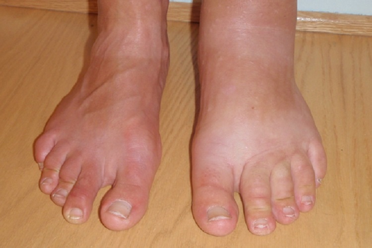 肢端肥大症脚部症状图