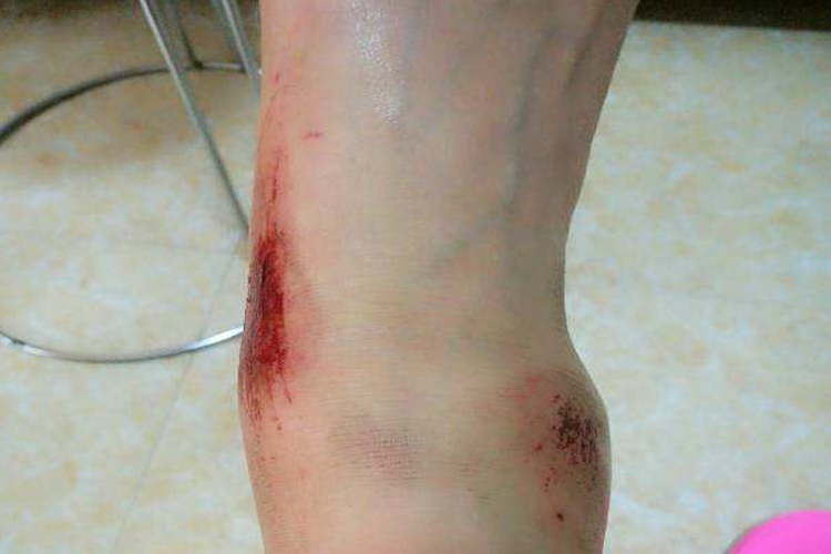 脚摔伤皮肤破损图 脚摔伤皮肤破损图