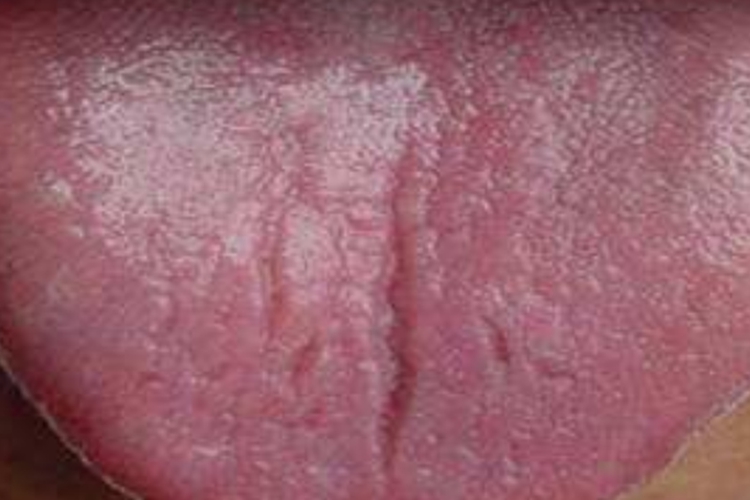 胃阴不足型慢性胃炎舌苔图 胃阴不足型慢性胃炎舌苔图