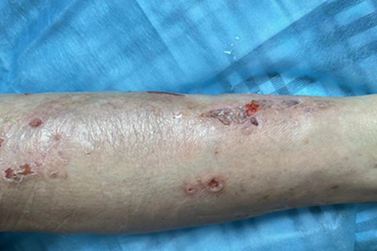 变应性血管炎小腿结痂图