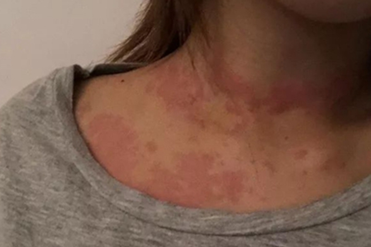 月经疹颈部有红斑丘疹图