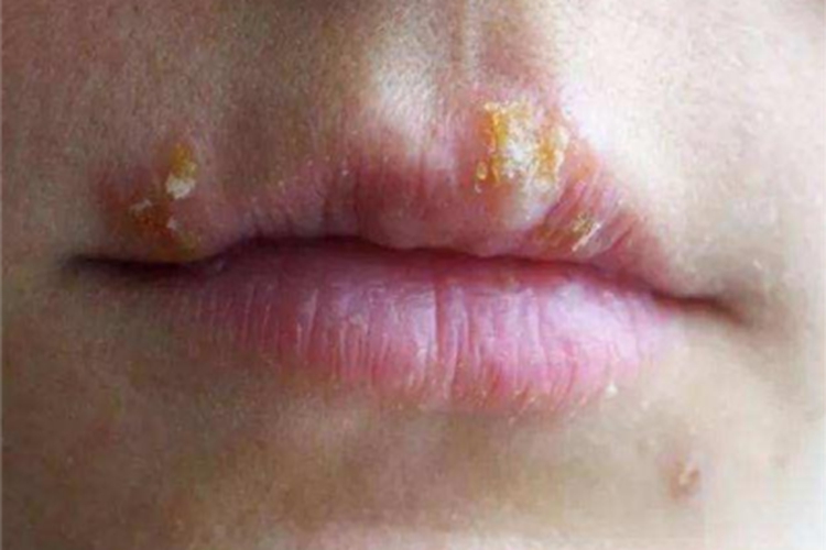 感染性口角炎嘴唇脓痂图 感染性口角炎嘴唇脓痂图