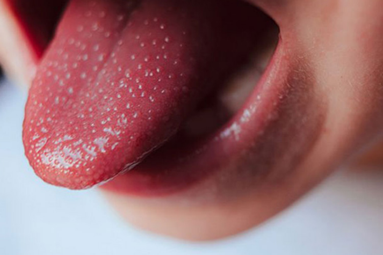 川崎病杨梅舌图 川崎病杨梅舌图