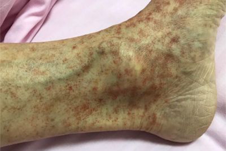 进行性色素性紫癜性皮病症状图