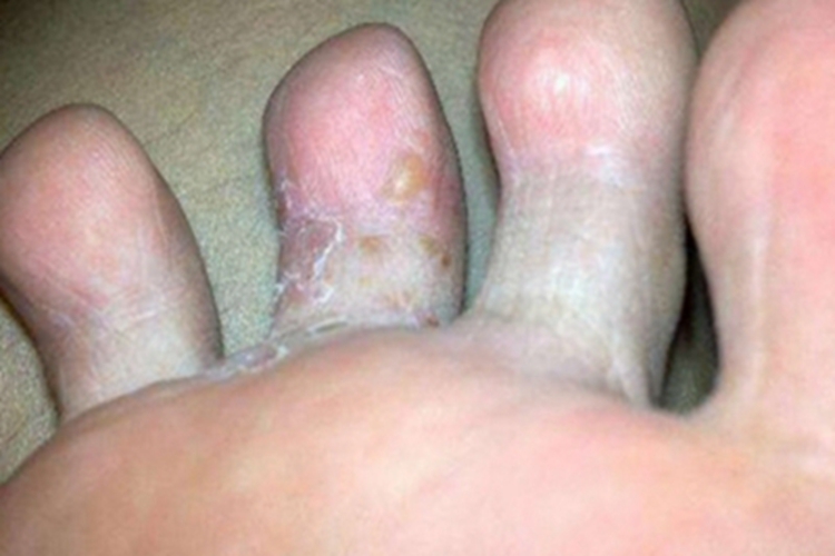 脚趾长水疱疱液发黄图