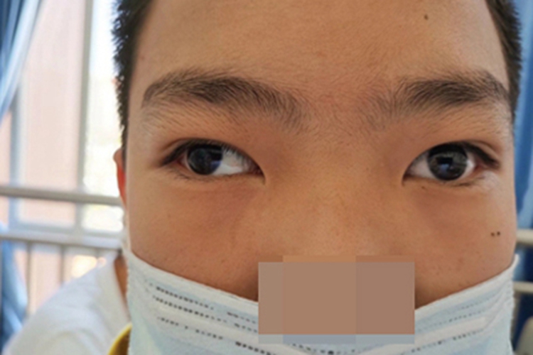 先天性共同性外斜视症状图 先天性共同性外斜视症状图