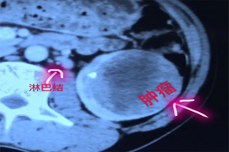 肾癌淋巴转移图
