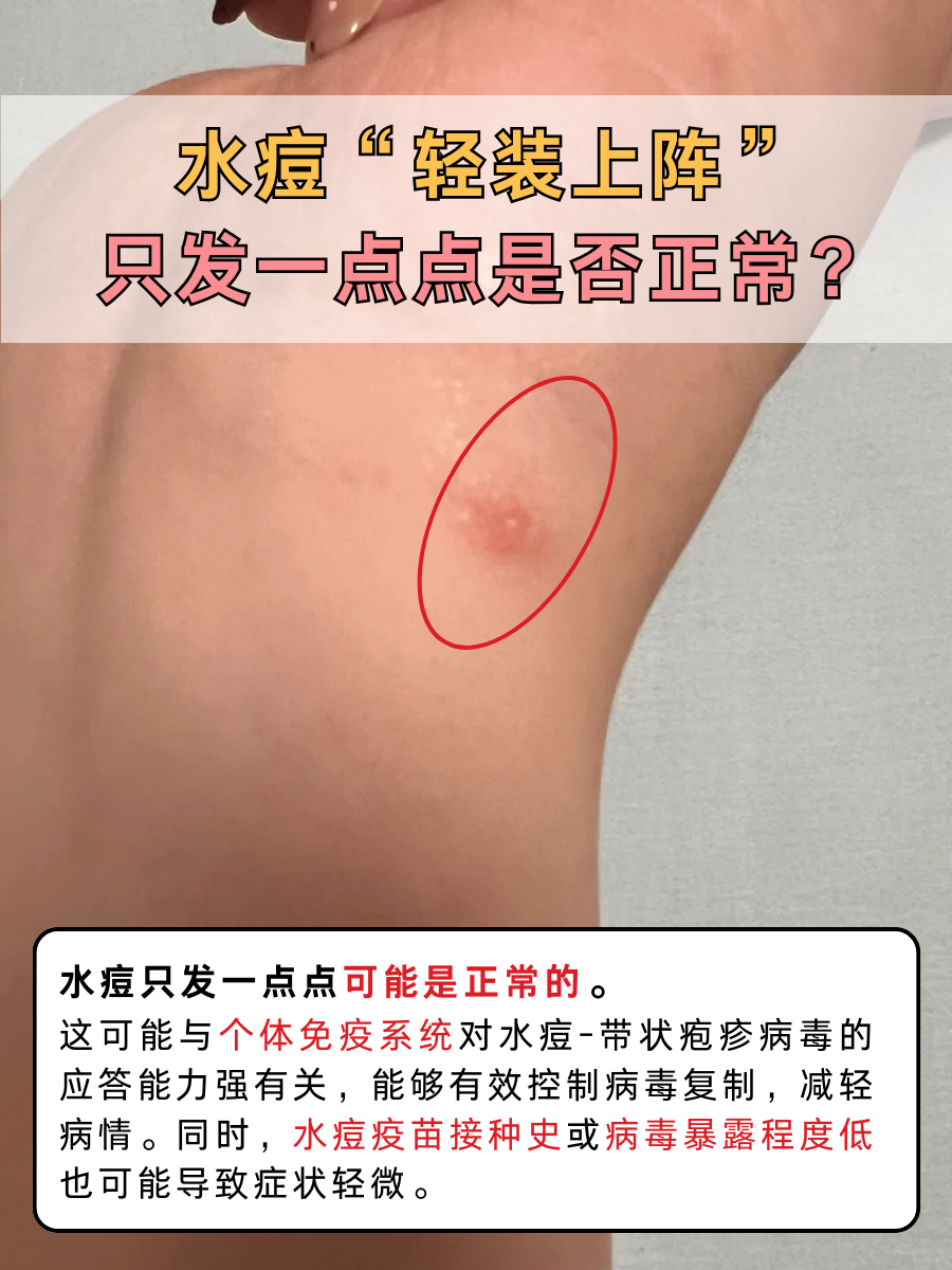 水痘“轻装上阵”，只发一点点是否正常？