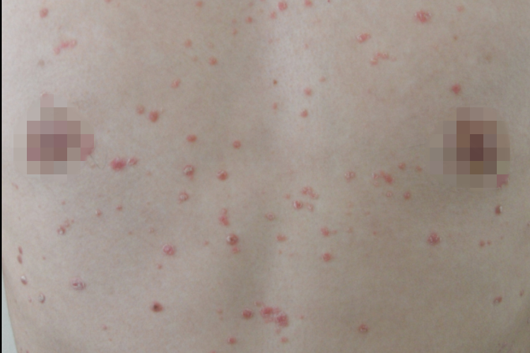 点滴状寻常型银屑病图