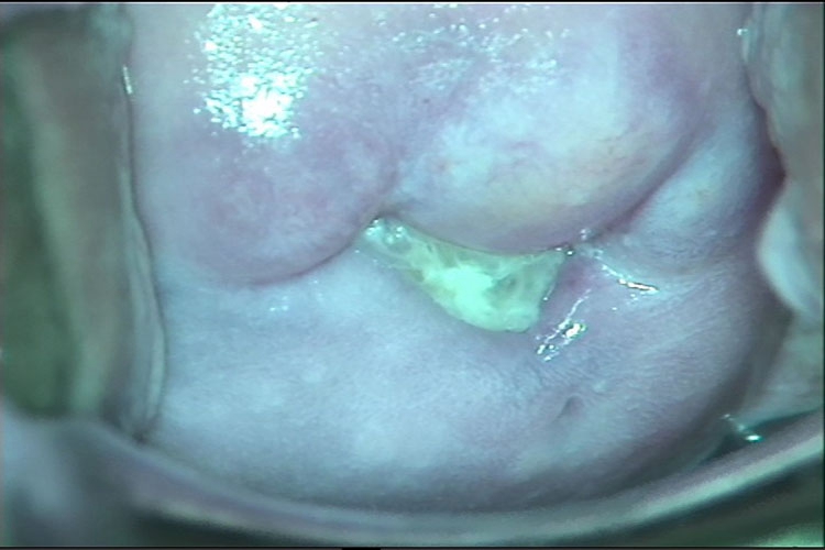 脓性分泌物图 脓性分泌物图