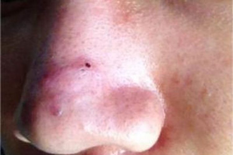 寻常痤疮鼻部疙瘩图 寻常痤疮鼻部疙瘩图