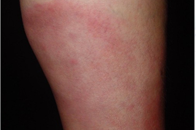 一氧化碳中毒小腿症状图