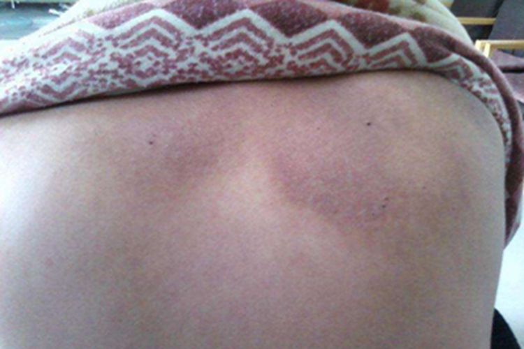 继发性皮肤淀粉样变背部结痂图 继发性皮肤淀粉样变背部结痂图