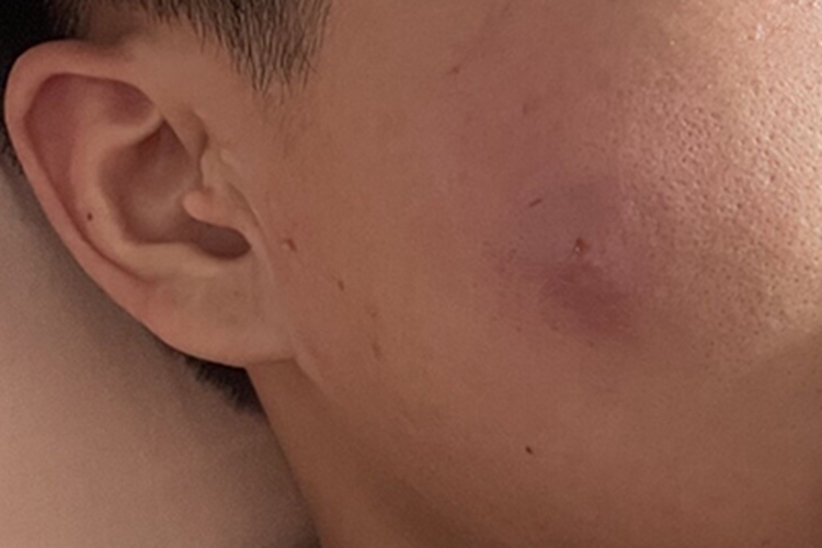 皮脂腺囊肿面部红肿图