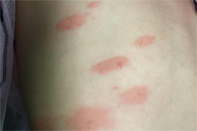 丘疹性荨麻疹皮损图 丘疹性荨麻疹皮损图