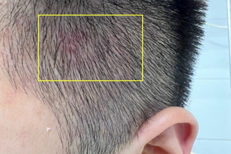 毛囊炎头皮上有包块图