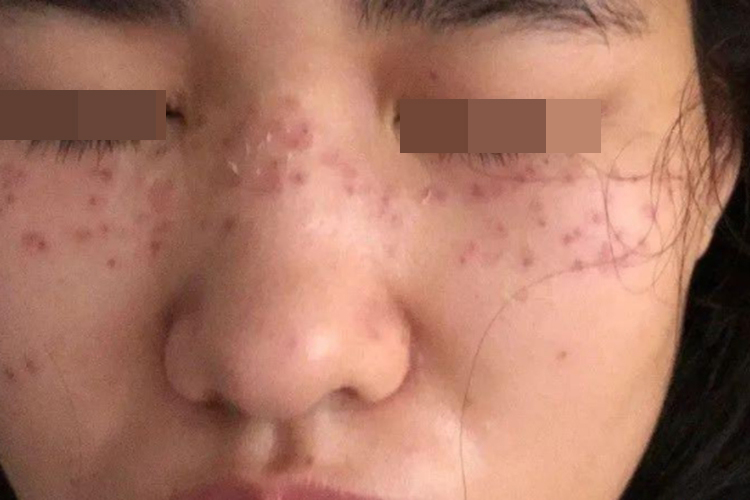 激光祛斑后发红图