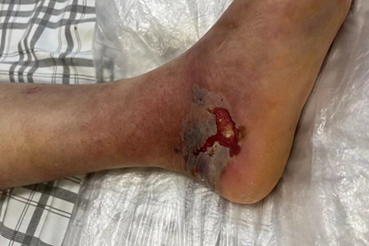 皮肤溃疡脚踝出血图 皮肤溃疡脚踝出血图