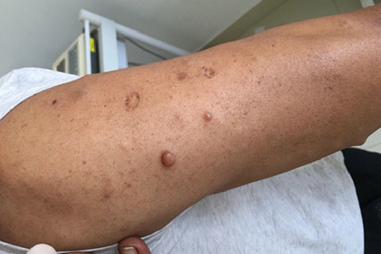 毛囊周围纤维瘤圆疙瘩图