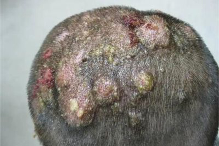 头癣分型不同,症状不同,其中脓癣皮损可表现为头皮处有脓包,毛囊口处