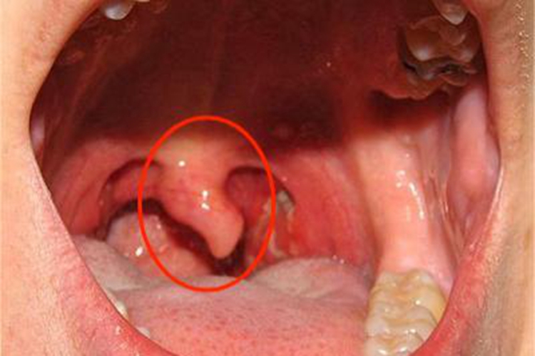 急性咽炎悬雍垂水肿图 急性咽炎悬雍垂水肿图