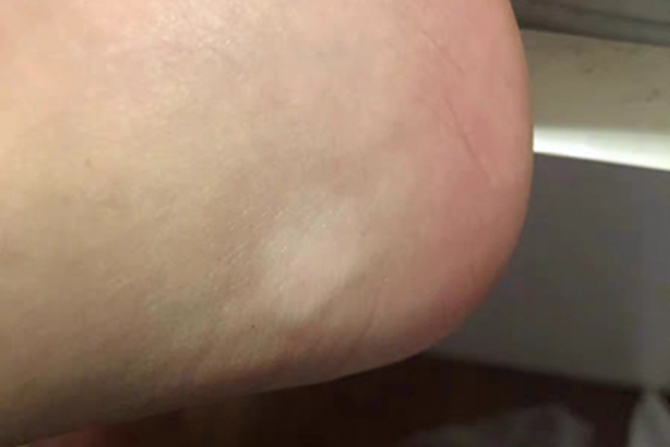 白癜风脚后跟白斑图 白癜风脚后跟白斑图