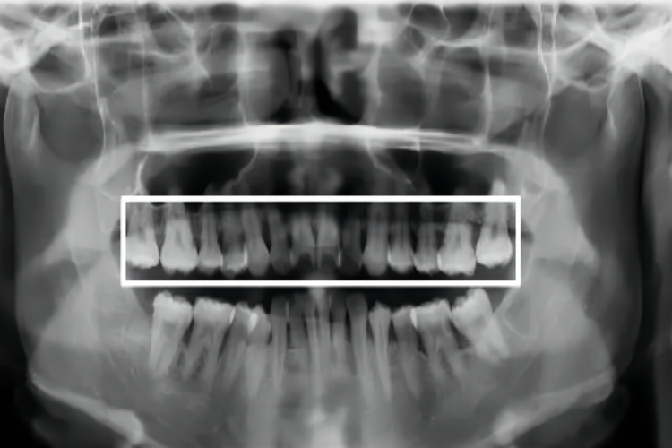 牙槽骨水平吸收X线片图