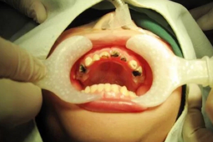 猖獗龋牙齿发黑烂了个坑图