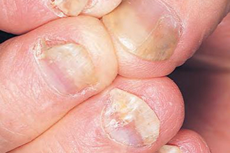 银屑病关节炎长条纹图 银屑病关节炎长条纹图