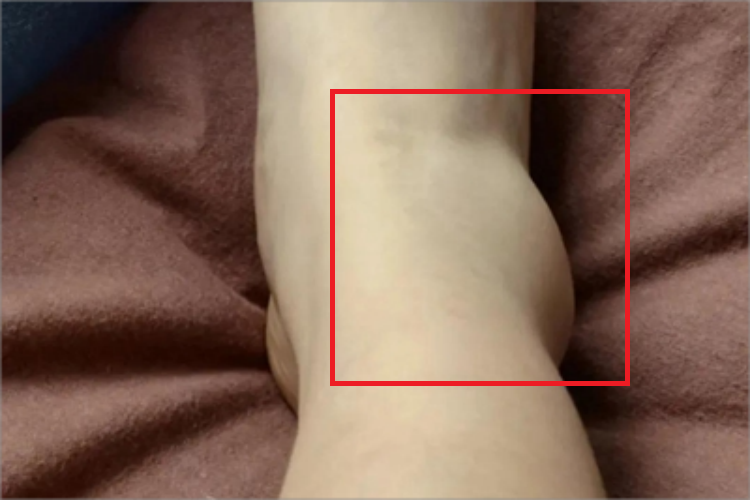 踝扭伤肿块图 踝扭伤肿块图