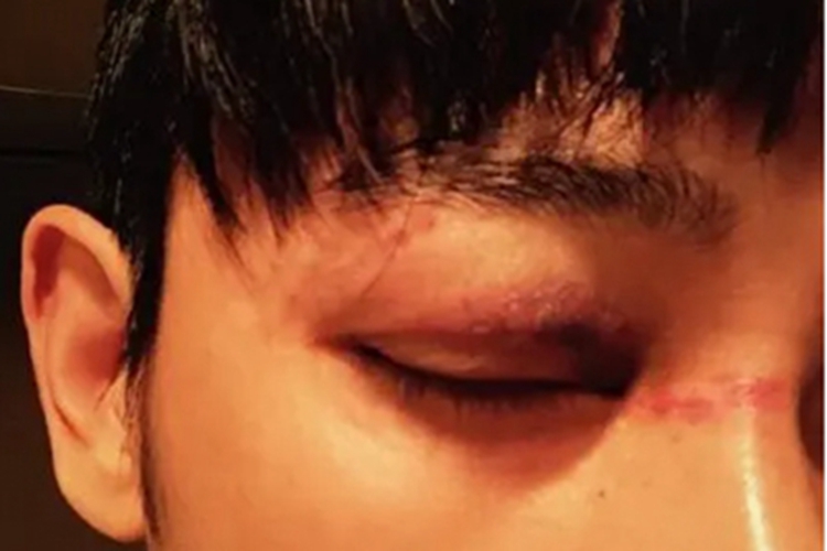 眼眶血肿上眼睑肿胀图