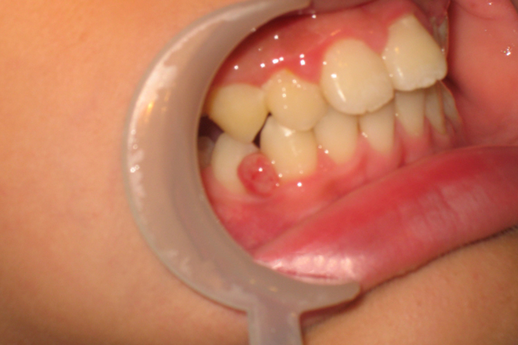 牙龈呈小球状轻微增生图