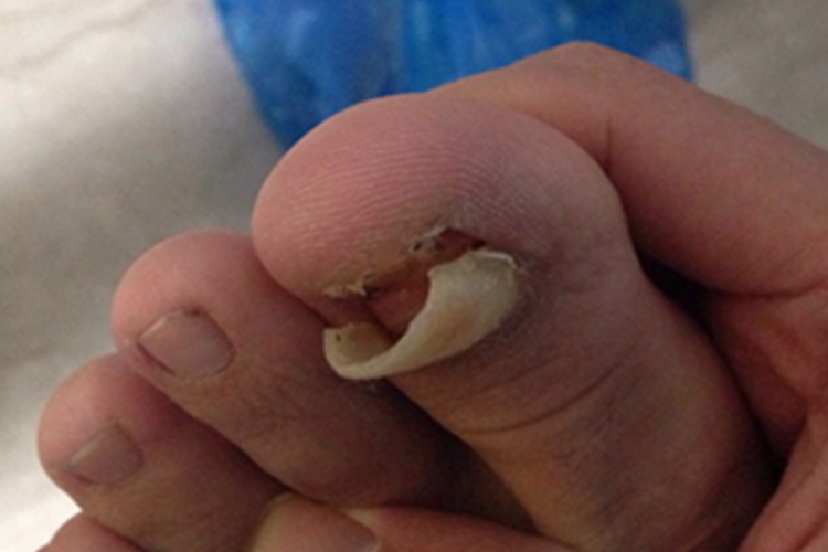 慢性甲沟炎脚趾甲翘起图