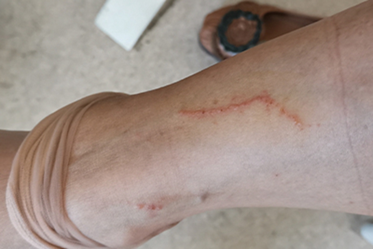 皮肤幼虫移行症小腿丘疹图