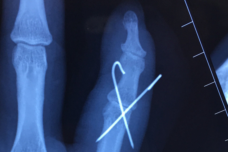 小手指关节固定图