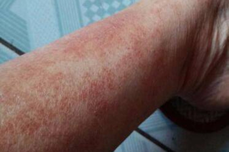 湿疹样紫癜腿红斑图 湿疹样紫癜腿红斑图