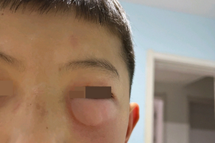 血管性水肿眼睑红肿图 血管性水肿眼睑红肿图