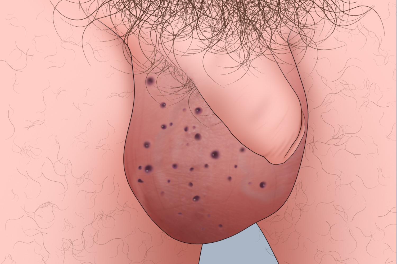 局限性血管角化瘤阴囊丘疹手绘图