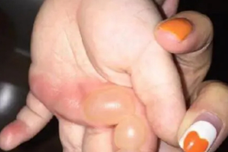 幼年型类天疱疮大水疱图