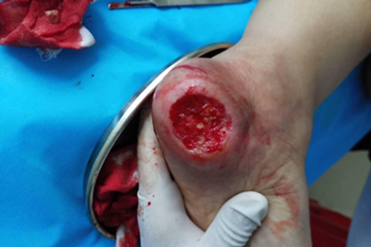 皮肤小血管炎脚后跟烂大洞图 皮肤小血管炎脚后跟烂大洞图