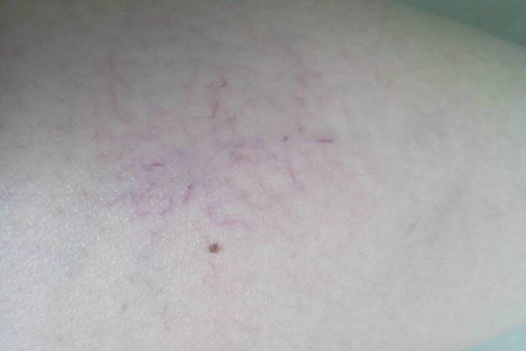 毛细血管扩张症图