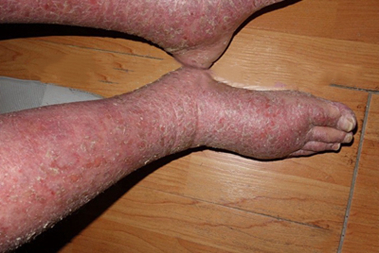 红皮病脱屑期小腿脱屑图 红皮病脱屑期小腿脱屑图