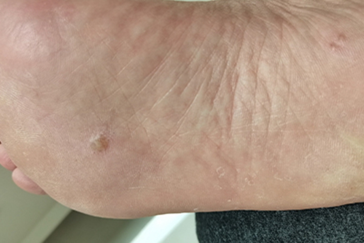 寻常疣脚底有小丘疹图 寻常疣脚底有小丘疹图