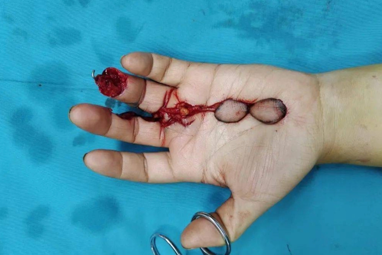 手部绞轧伤图