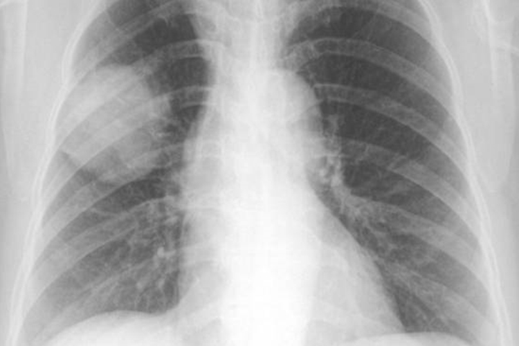 右肺周围型肺癌胸片图