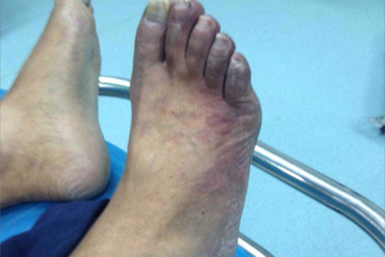 0级糖尿病足皮肤发紫图 0级糖尿病足皮肤发紫图