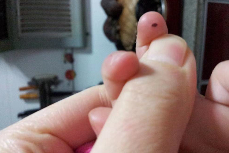 色素痣宝宝手指长小黑点图