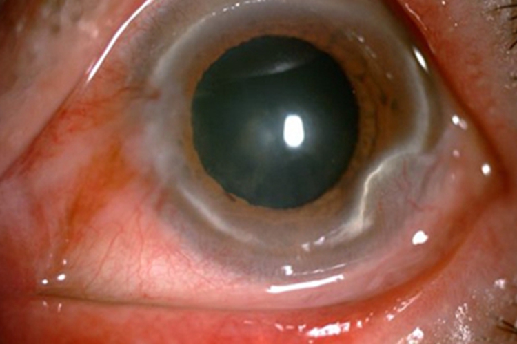 蚕蚀性角膜溃疡黑眼球有白斑图 蚕蚀性角膜溃疡黑眼球有白斑图