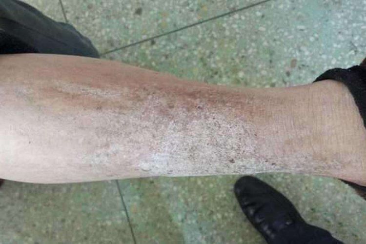 慢性湿疹小腿皮损图 慢性湿疹小腿皮损图