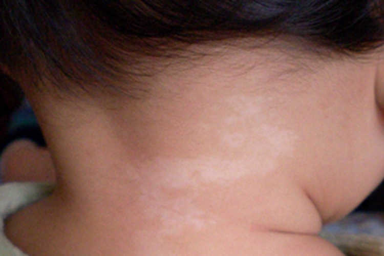 白癜风后颈白斑图 白癜风后颈白斑图